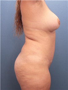 Buttock Lift with Augmentation Before Photo by Marvin Shienbaum, MD; Brandon, FL - Case 35011