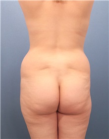 Buttock Lift with Augmentation Before Photo by Marvin Shienbaum, MD; Brandon, FL - Case 35016