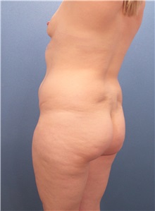 Buttock Lift with Augmentation Before Photo by Marvin Shienbaum, MD; Brandon, FL - Case 35016