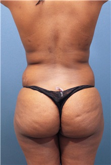 Buttock Lift with Augmentation Before Photo by Marvin Shienbaum, MD; Brandon, FL - Case 35017