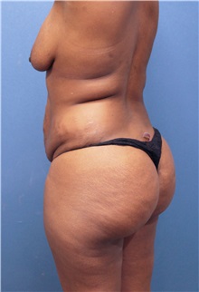 Buttock Lift with Augmentation Before Photo by Marvin Shienbaum, MD; Brandon, FL - Case 35017