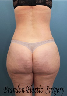 Buttock Lift with Augmentation After Photo by Marvin Shienbaum, MD; Brandon, FL - Case 35018