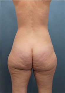 Buttock Lift with Augmentation Before Photo by Marvin Shienbaum, MD; Brandon, FL - Case 35018