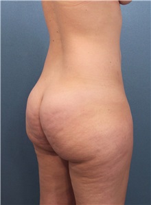 Buttock Lift with Augmentation Before Photo by Marvin Shienbaum, MD; Brandon, FL - Case 35018