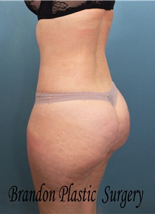 Buttock Lift with Augmentation After Photo by Marvin Shienbaum, MD; Brandon, FL - Case 35018