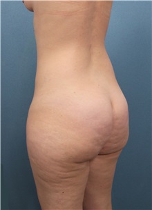 Buttock Lift with Augmentation Before Photo by Marvin Shienbaum, MD; Brandon, FL - Case 35018