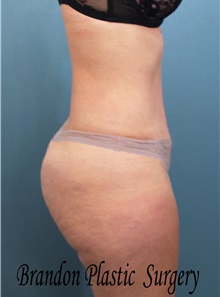 Buttock Lift with Augmentation After Photo by Marvin Shienbaum, MD; Brandon, FL - Case 35018