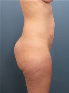 Buttock Lift with Augmentation Before Photo by Marvin Shienbaum, MD; Brandon, FL - Case 35018