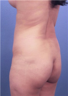 Buttock Lift with Augmentation Before Photo by Marvin Shienbaum, MD; Brandon, FL - Case 35019