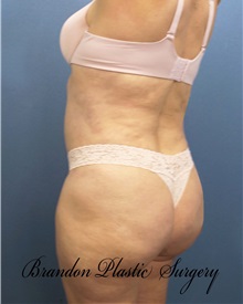 Buttock Lift with Augmentation After Photo by Marvin Shienbaum, MD; Brandon, FL - Case 35020