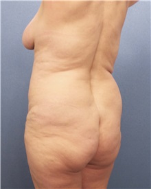 Buttock Lift with Augmentation Before Photo by Marvin Shienbaum, MD; Brandon, FL - Case 35020