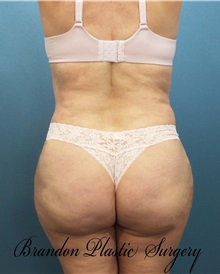 Buttock Lift with Augmentation After Photo by Marvin Shienbaum, MD; Brandon, FL - Case 35020