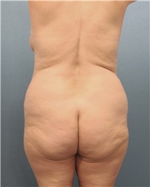 Buttock Lift with Augmentation Before Photo by Marvin Shienbaum, MD; Brandon, FL - Case 35020