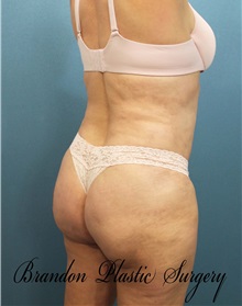 Buttock Lift with Augmentation After Photo by Marvin Shienbaum, MD; Brandon, FL - Case 35020