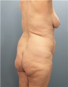 Buttock Lift with Augmentation Before Photo by Marvin Shienbaum, MD; Brandon, FL - Case 35020