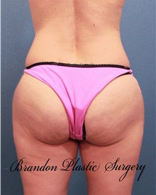 Buttock Lift with Augmentation After Photo by Marvin Shienbaum, MD; Brandon, FL - Case 35021