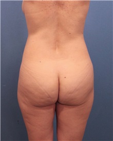 Buttock Lift with Augmentation Before Photo by Marvin Shienbaum, MD; Brandon, FL - Case 35021