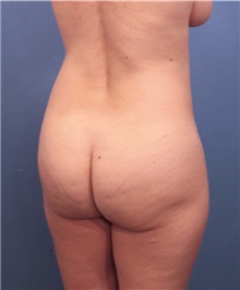 Buttock Lift with Augmentation Before Photo by Marvin Shienbaum, MD; Brandon, FL - Case 35021