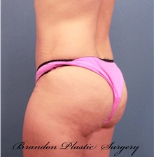 Buttock Lift with Augmentation After Photo by Marvin Shienbaum, MD; Brandon, FL - Case 35021