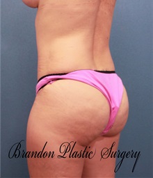 Buttock Lift with Augmentation After Photo by Marvin Shienbaum, MD; Brandon, FL - Case 35021