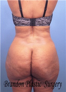 Buttock Lift with Augmentation After Photo by Marvin Shienbaum, MD; Brandon, FL - Case 35022