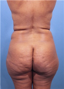 Buttock Lift with Augmentation Before Photo by Marvin Shienbaum, MD; Brandon, FL - Case 35022