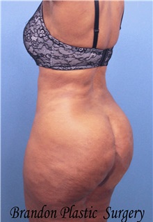 Buttock Lift with Augmentation After Photo by Marvin Shienbaum, MD; Brandon, FL - Case 35022