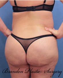 Buttock Lift with Augmentation After Photo by Marvin Shienbaum, MD; Brandon, FL - Case 37221