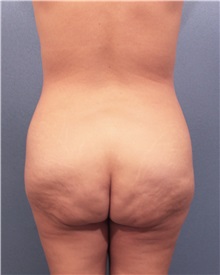 Buttock Lift with Augmentation Before Photo by Marvin Shienbaum, MD; Brandon, FL - Case 37221