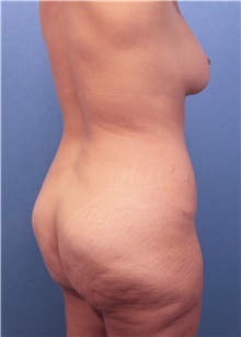 Buttock Lift with Augmentation Before Photo by Marvin Shienbaum, MD; Brandon, FL - Case 37221