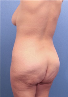 Buttock Lift with Augmentation Before Photo by Marvin Shienbaum, MD; Brandon, FL - Case 37221