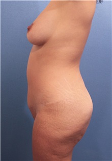 Buttock Lift with Augmentation Before Photo by Marvin Shienbaum, MD; Brandon, FL - Case 37221