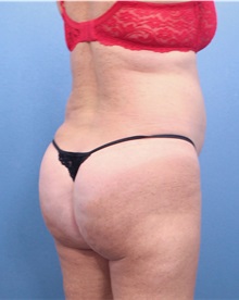 Buttock Lift with Augmentation After Photo by Marvin Shienbaum, MD; Brandon, FL - Case 37222