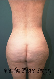 Buttock Lift with Augmentation After Photo by Marvin Shienbaum, MD; Brandon, FL - Case 37223