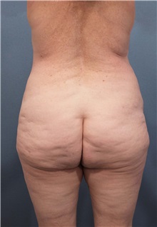 Buttock Lift with Augmentation Before Photo by Marvin Shienbaum, MD; Brandon, FL - Case 37223