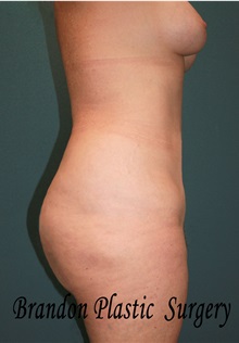 Buttock Lift with Augmentation After Photo by Marvin Shienbaum, MD; Brandon, FL - Case 37223