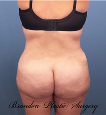 Buttock Lift with Augmentation After Photo by Marvin Shienbaum, MD; Brandon, FL - Case 37225