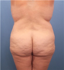 Buttock Lift with Augmentation Before Photo by Marvin Shienbaum, MD; Brandon, FL - Case 37225