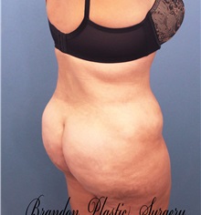 Buttock Lift with Augmentation After Photo by Marvin Shienbaum, MD; Brandon, FL - Case 37225