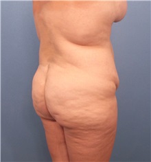 Buttock Lift with Augmentation Before Photo by Marvin Shienbaum, MD; Brandon, FL - Case 37225