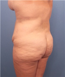 Buttock Lift with Augmentation Before Photo by Marvin Shienbaum, MD; Brandon, FL - Case 37225