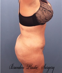 Buttock Lift with Augmentation After Photo by Marvin Shienbaum, MD; Brandon, FL - Case 37225