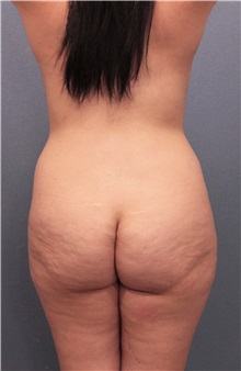 Buttock Lift with Augmentation Before Photo by Marvin Shienbaum, MD; Brandon, FL - Case 37261