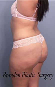 Buttock Lift with Augmentation After Photo by Marvin Shienbaum, MD; Brandon, FL - Case 37261