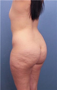 Buttock Lift with Augmentation Before Photo by Marvin Shienbaum, MD; Brandon, FL - Case 37261