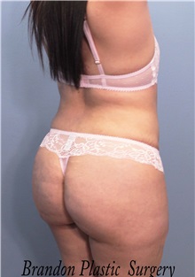 Buttock Lift with Augmentation After Photo by Marvin Shienbaum, MD; Brandon, FL - Case 37261