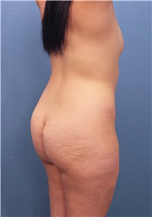 Buttock Lift with Augmentation Before Photo by Marvin Shienbaum, MD; Brandon, FL - Case 37261