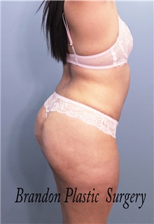 Buttock Lift with Augmentation After Photo by Marvin Shienbaum, MD; Brandon, FL - Case 37261