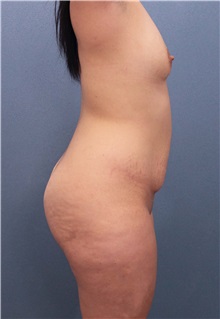 Buttock Lift with Augmentation Before Photo by Marvin Shienbaum, MD; Brandon, FL - Case 37261