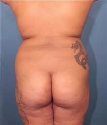 Buttock Lift with Augmentation Before Photo by Marvin Shienbaum, MD; Brandon, FL - Case 37262